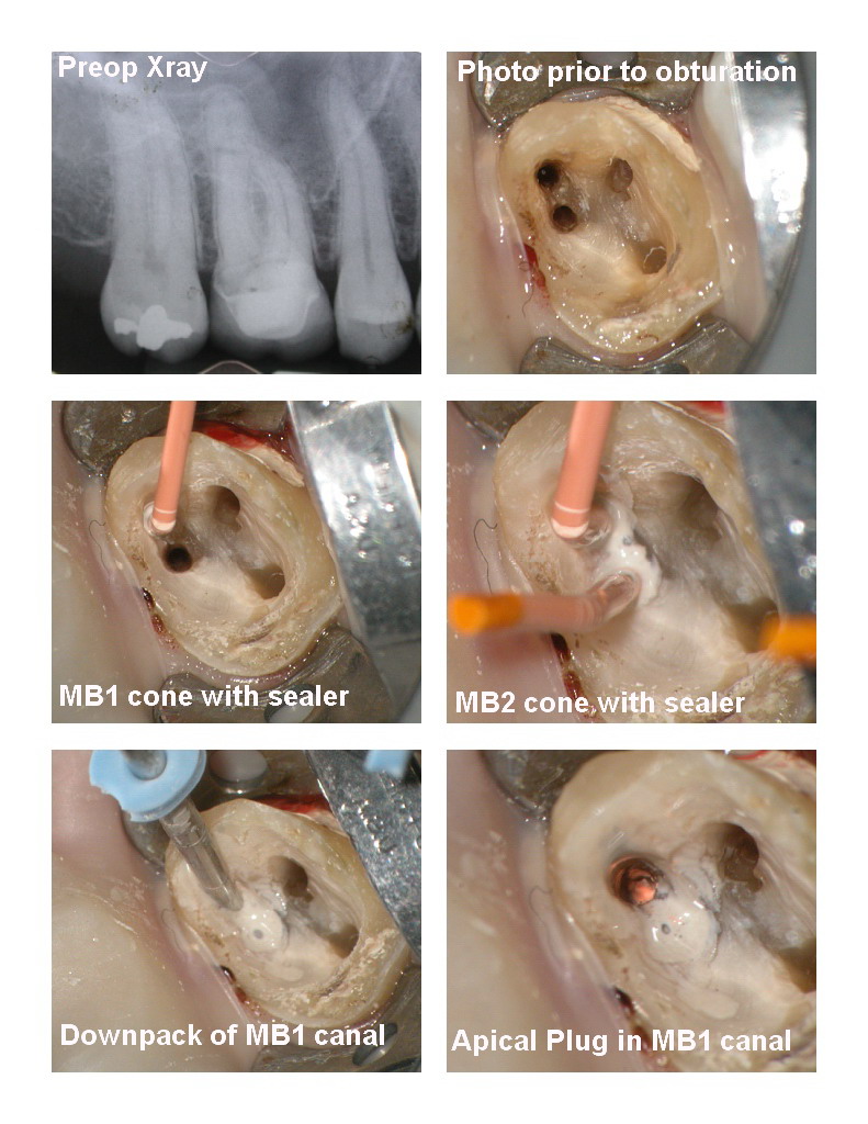 Endo first molar pg 1.jpg